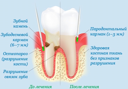 parodentium 85