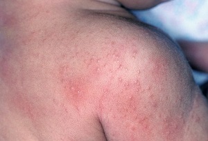 sun allergy rash pictures