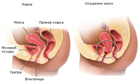 opushhenie matki