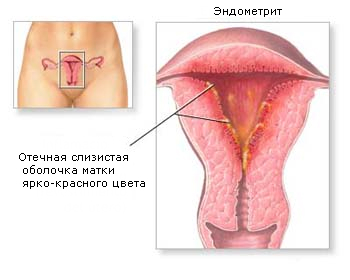 endometrit