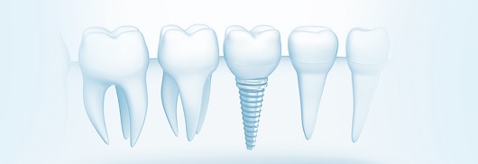 olivadent implant