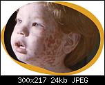 
          
: Measles-3.jpg
: 328
: 23.8 
ID: 7020
    