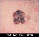 melanoma