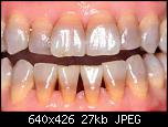 
          
: tetracycline_teeth.jpg
: 110
: 27.1 
ID: 17388
    