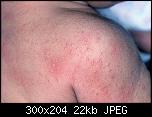 sun allergy rash pictures