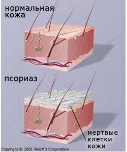 1psoriaz.jpg
