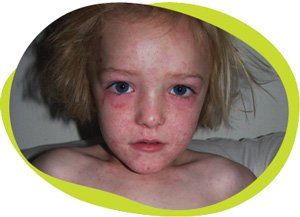 measles-300-w.jpg