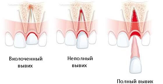 Вывих зуба.jpg