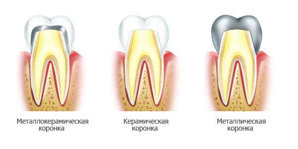 metallokeramicheskie-zubnye-koronki.jpg