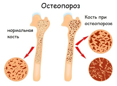 Остеопороз.jpg