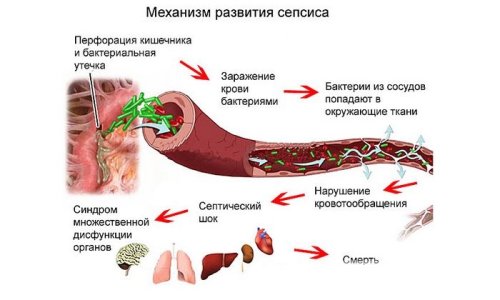 Сепсис.jpg