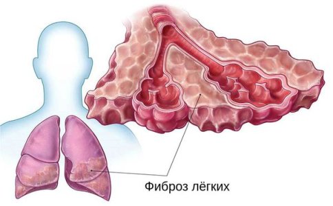 Фиброз легких.jpg